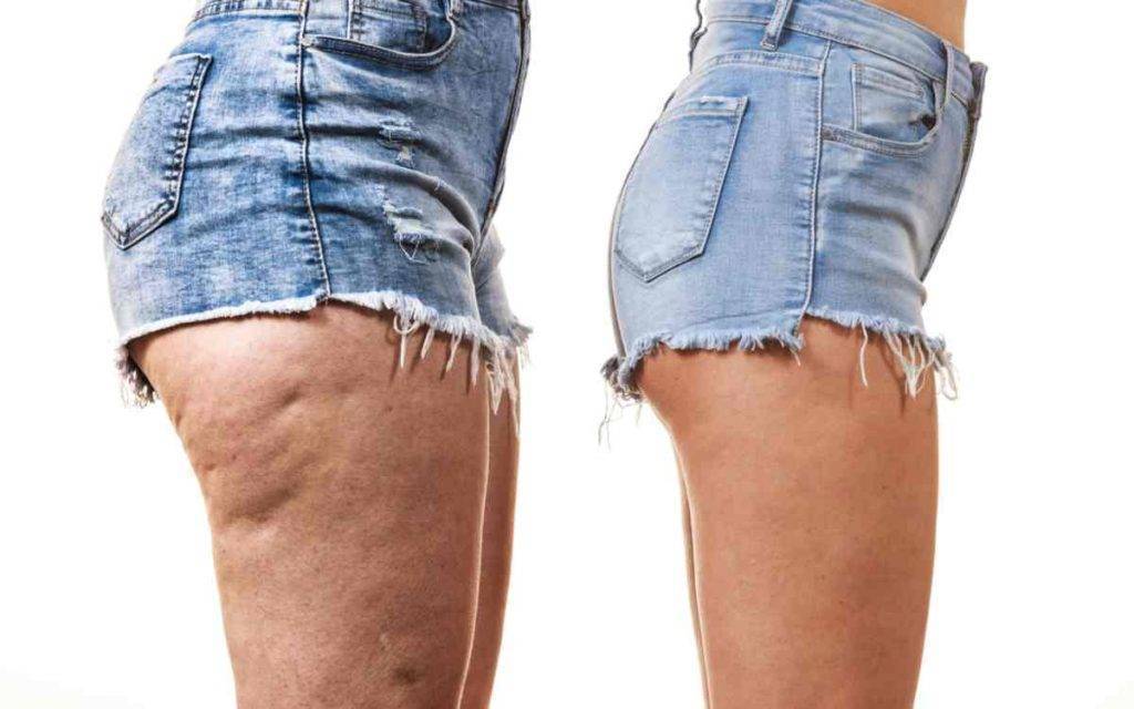 cellulite e ritenzione idrica