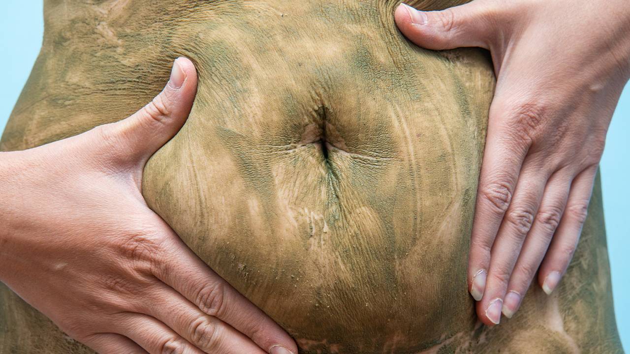 Rimedi contro la cellulite. I fanghi fatti in casa