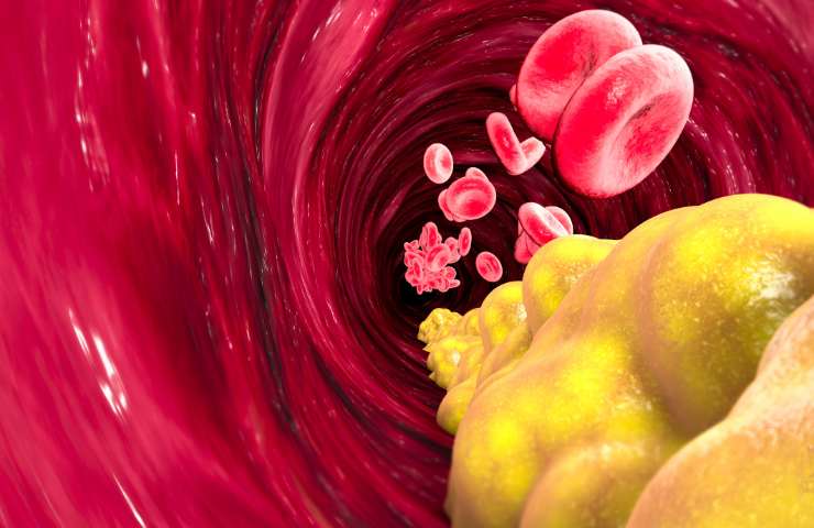 Una rappresentazione di come agisce il colesterolo all'interno delle arterie