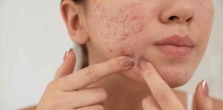 Troppi brufoli sulla pelle e rughe in aumento, tutta colpa di questo alimento - RicettaSprint