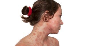 La dermatite atopica può essere contrastata abbassando il consumo di sale