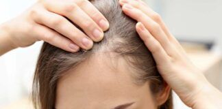 Donna problemi capelli