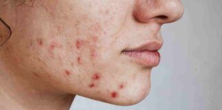 Acne da cibo cambia subito dieta - RicettaSprint