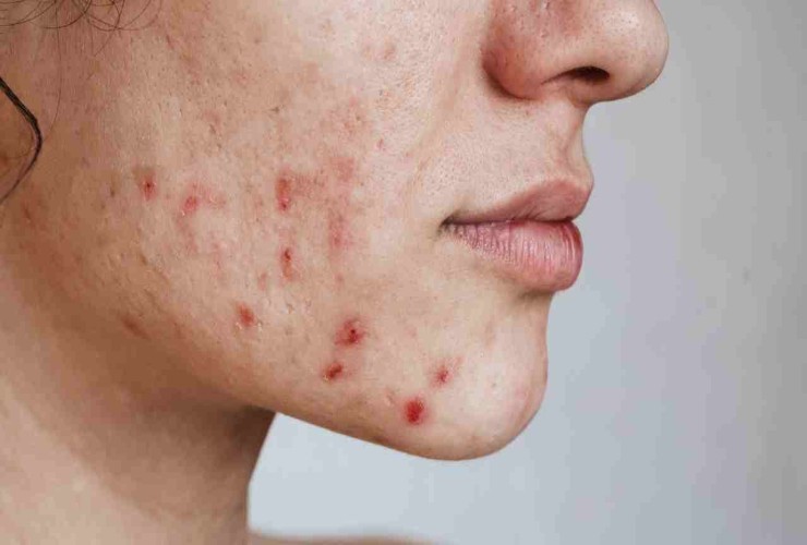 Acne sul viso RicettaSprint