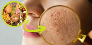 Alimentazione e acne RicettaSprint