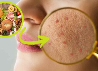 Alimentazione e acne RicettaSprint