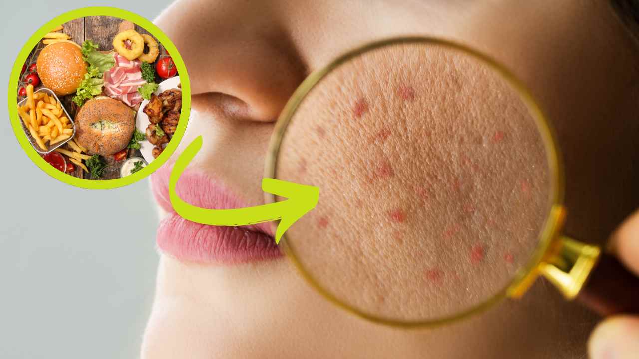 Alimentazione e acne RicettaSprint