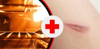 Una scottatura su un braccio ed un forno acceso