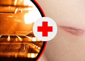 Una scottatura su un braccio ed un forno acceso