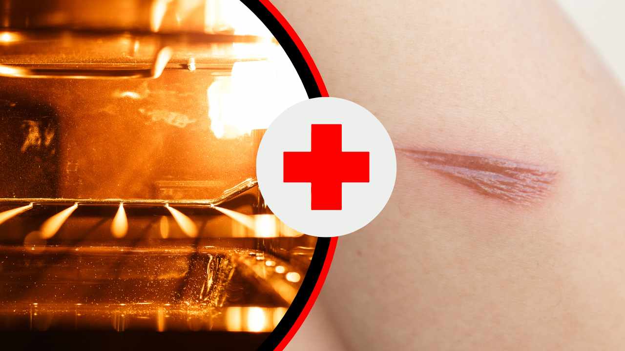 Una scottatura su un braccio ed un forno acceso