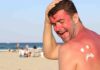 Scottature solari rimedio naturale - RicettaSprint