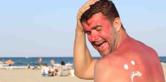 Scottature solari rimedio naturale - RicettaSprint