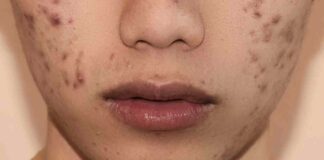 Cibo contro acne, ciò che mangi peggiora o migliora la pelle (e non è solo il cioccolato) Cibo acne dieta - RicettaSprint