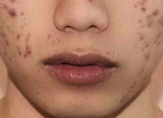 Cibo contro acne, ciò che mangi peggiora o migliora la pelle (e non è solo il cioccolato) Cibo acne dieta - RicettaSprint