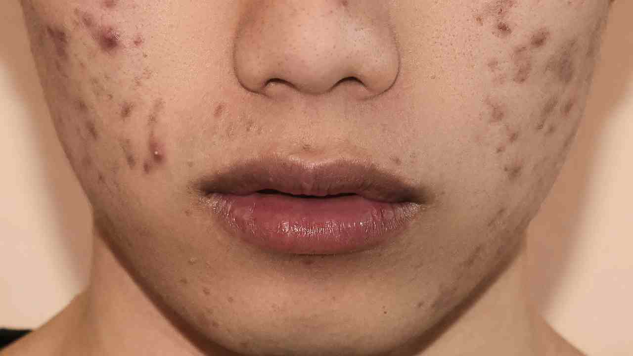 Cibo acne dieta - RicettaSprint