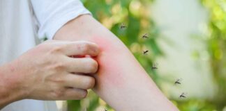 Punture di insetti rimedi naturali - RicettaSprint