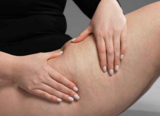 Addio cellulite, il primo passo è togliere questi cibi dalla dispensa Cibi da evitare per la pelle a buccia d'arancia - RicettaSprint